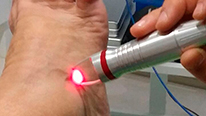 tratamiento-laser Personalizadas - Laser Clipie